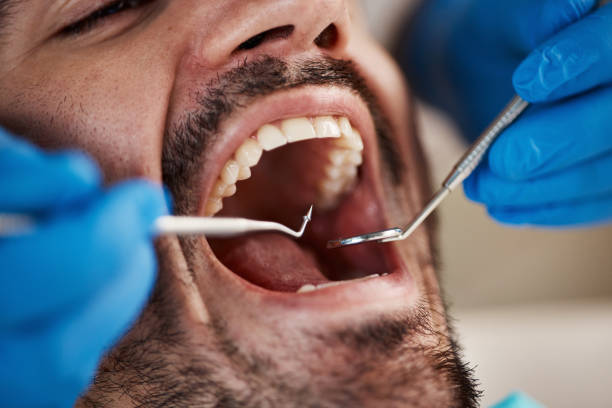 Best Emergency Dental Care for Broken or Chipped Teeth in Millersville, TN